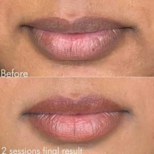 lip neutralization